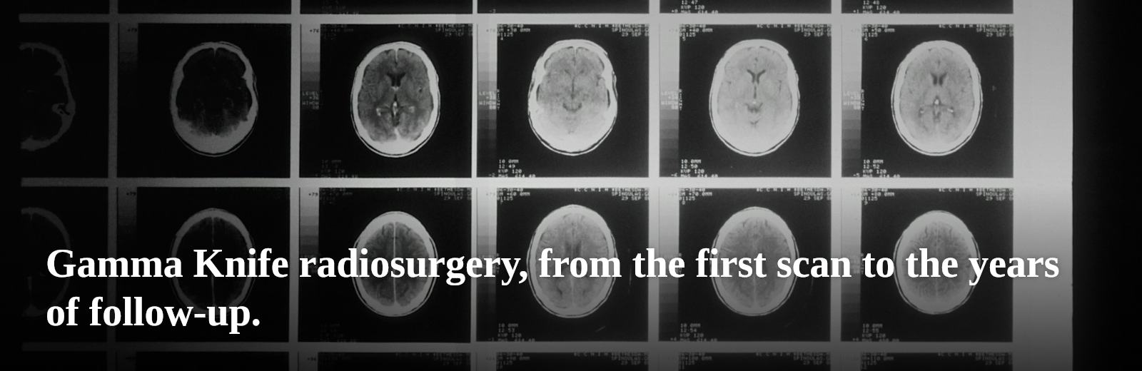 Gamma Knife radiosurgery, from the first scan to the years of follow-up.